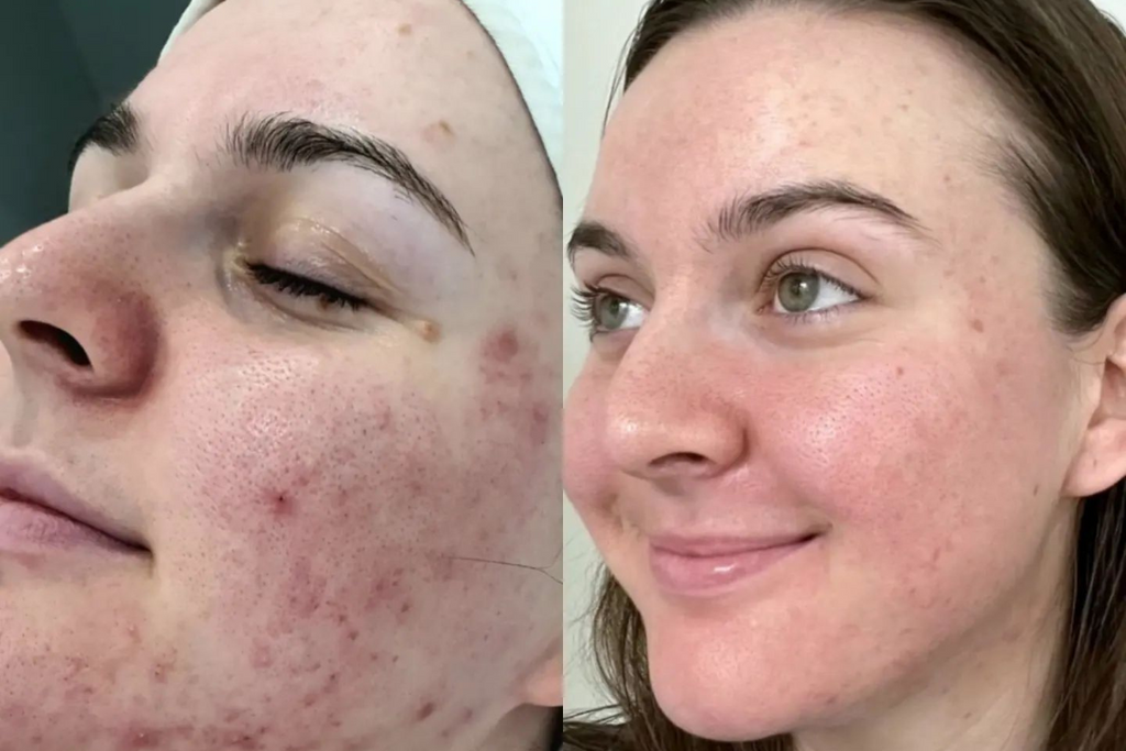 Why You Need a Custom Facial