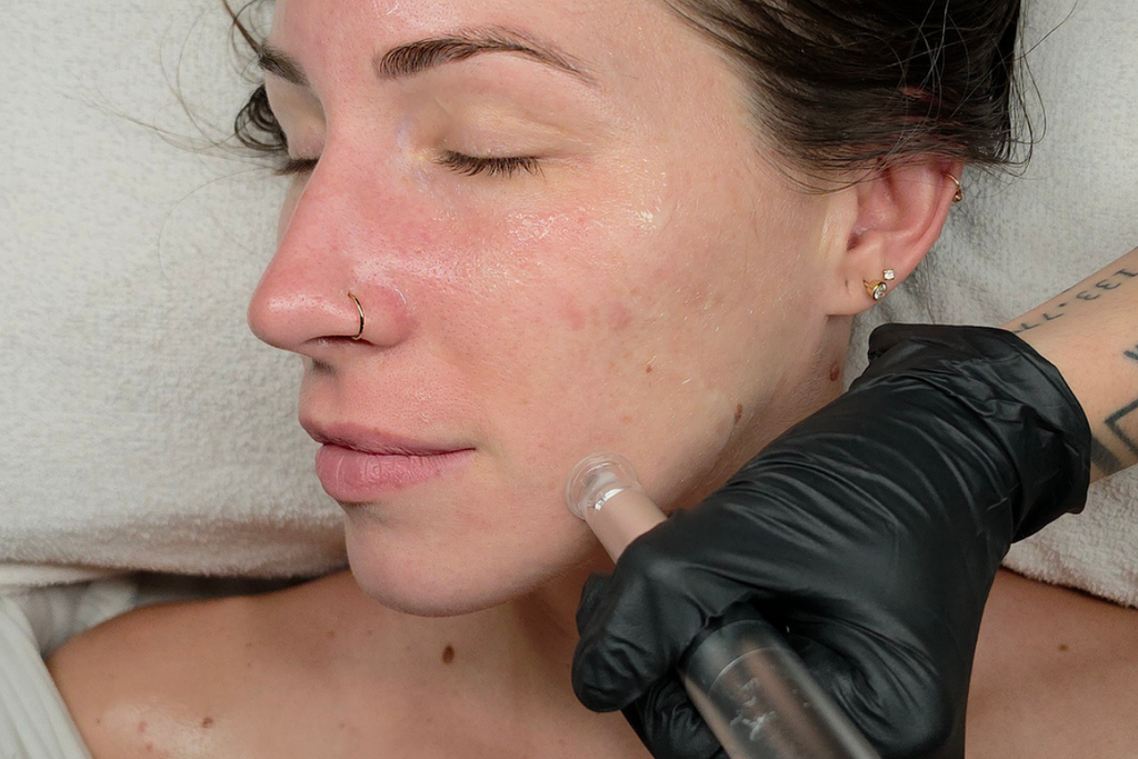 Skin Needling vs Nano Infusion: Which Treatment Is Right For You?